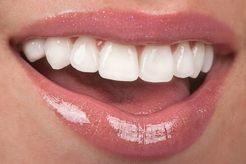 Invisalign Treatment