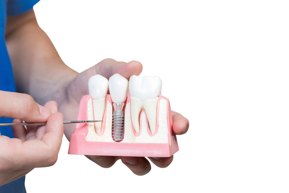 Benefits and advantages of Dental Implants